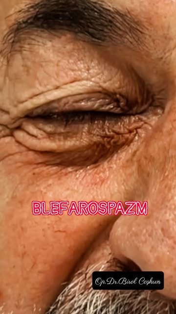 Blefaroplasti (göz kapağı estetiği) konulu Instagram paylaşımı